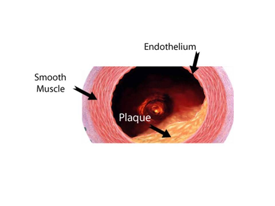 Arterial plaque buildup